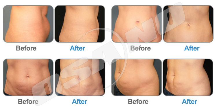 before and after cool lipolysis treatment