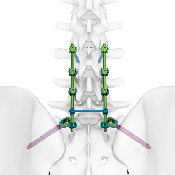 TINA Spine 5.5/6.0 System